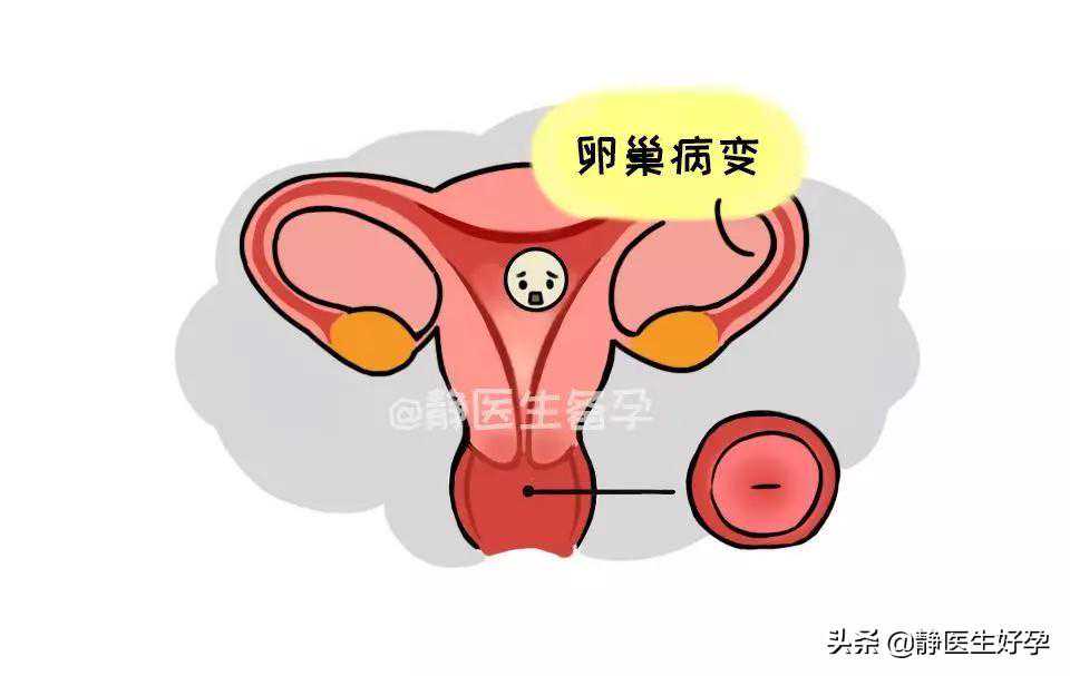 备孕遇上排卵障碍，3个小妙招有效促排卵！